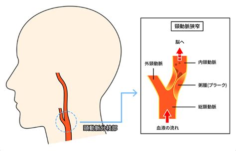 首 脈|頸部頸動脈狭窄症 (けいぶけいどうみゃくきょうさくしょう)とは。